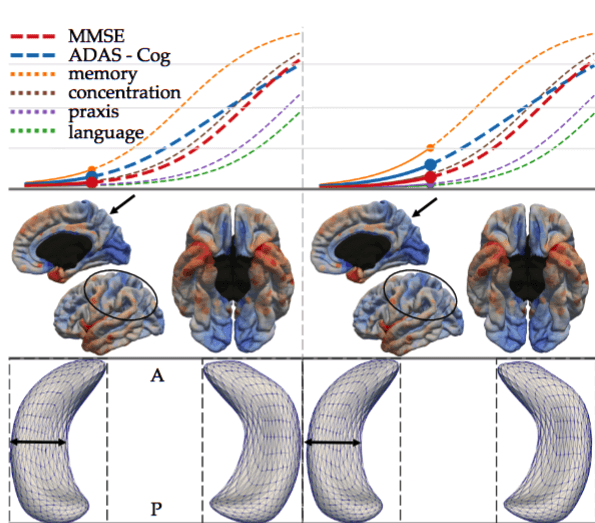 Simulating Alzheimer’s Disease Progression with Personalised Digital Brain Models